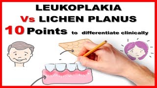 How to clear white patch in the mouth  LASER SURGERY FOR LEUKOPLAKIA LIVE SURGERY [upl. by Huntlee]