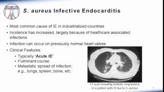 Endocarditis  Cardiac Pathology🫀 [upl. by Bugbee644]