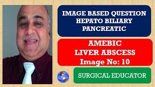 AMEBIC LIVER ABSCESS  Hepato Biliary Pancreatic Imge 10 [upl. by Ttocs]