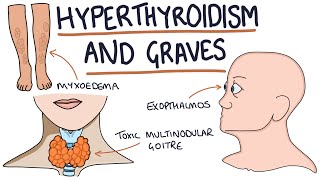 Understanding Hyperthyroidism and Graves Disease [upl. by Kurr]