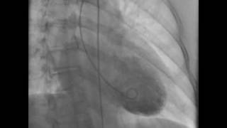 Takotsubo Cardiomyopathy Caught on Tape [upl. by Nirehtak]