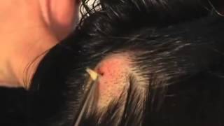 The Botfly in the Head [upl. by Orose]