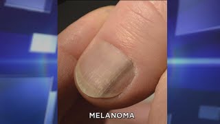 Subungual Melanoma What You Need to Know [upl. by Butterworth]