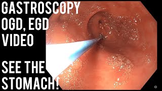 Gastroscopy  OGD  See inside the stomach [upl. by Bathsheba]