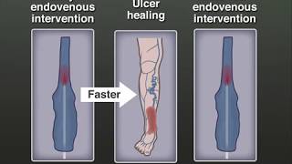 Treating Venous Leg Ulcers [upl. by Ahsinrad807]