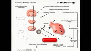 Takotsubo Cardiomyopathy I am Seeing it Everywhere [upl. by Sulakcin]