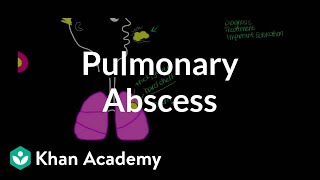 Pulmonary abscess  Respiratory system diseases  NCLEXRN  Khan Academy [upl. by Allyn]