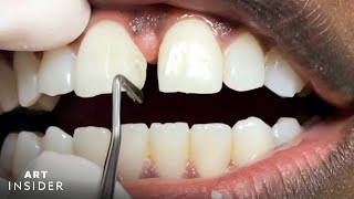 How Tooth Gaps Are Filled  Insider Art [upl. by Ecinreb651]