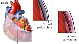 Pericarditis [upl. by Atirec]