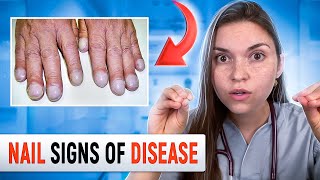 Doctor Explains what your NAILS say about your HEALTH Top 10 Nail Problems [upl. by Oiril143]