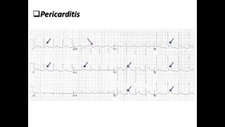 Constrictive pericarditis Etiology and presentation [upl. by Rebmik]