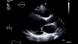 Ischemic Cardiomyopathy 2D Echocardiogram [upl. by Kyl]