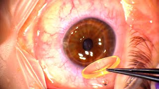 Corneal Transplant Penetrating Keratoplasty for Advanced Keratoconus and Corneal Infiltrates [upl. by Ackley959]