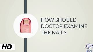 HOW AND WHY SHOULD DOCTOR EXAMINE THE NAILS [upl. by Asirap]