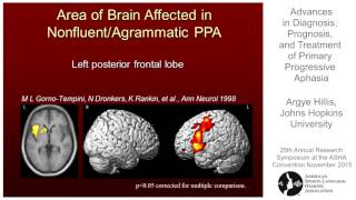 Argye Hillis Advances in Diagnosis Prognosis and Treatment of Primary Progressive Aphasia [upl. by Htrowslle798]