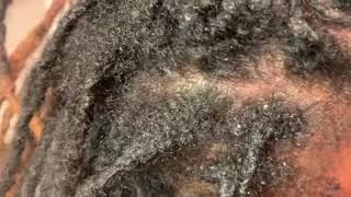 How to remove scalesdandruff or seborrheic dermatitis from the scalp [upl. by Rundgren802]