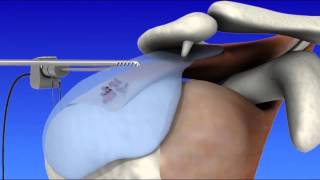 Shoulder Arthroscopy [upl. by Abeu131]