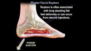 Plantar Fascia Rupture  Everything You Need To Know  Dr Nabil Ebraheim [upl. by Germana933]