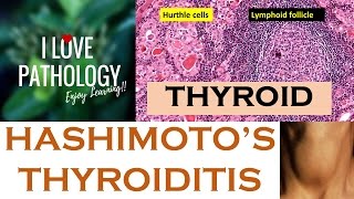 HASHIMOTOS THYROIDITIS Etiopathogenesis Morphology amp Complications [upl. by Kalina]