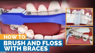 How to Brush amp Floss with Braces [upl. by Elizabeth]