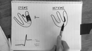 STsegment changes in STEMI amp NSTEMI explained [upl. by Ardnala]