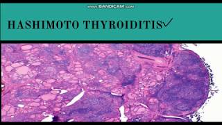 HASHIMOTOS Thyroiditis 5 Things YOU Need to Know 2024 [upl. by Mccollum]