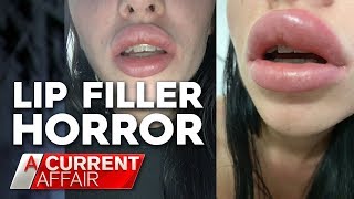 This method of getting facial filler will make you look older NOT younger AVOID at all costs [upl. by Aylmar]