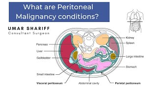 Peritoneal Malignancy conditions [upl. by Heyra]