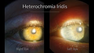 Fuchs Heterochromic Iridocyclitis  Ophthalmology cases [upl. by Lyle]