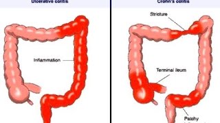 Crohn Disease [upl. by Nosnev]