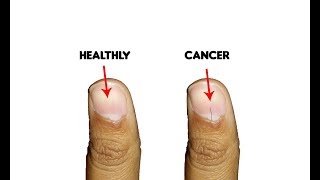 9 Fingernails serious alarming health issues and probllems [upl. by Tisbee]