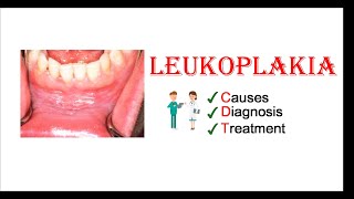 Leukoplakia  Causes Diagnosis amp Treatment [upl. by Lsil]