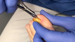 Usuwanie wrastającego fragmentu paznokcia  Ingrown toenail removal [upl. by Leupold]