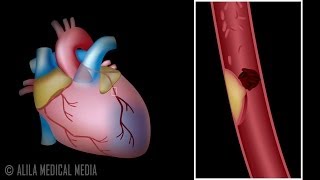 Myocardial Infarction and Coronary Angioplasty Treatment Animation [upl. by Arbas74]