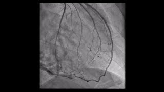 Constrictive Pericarditis [upl. by Abey]