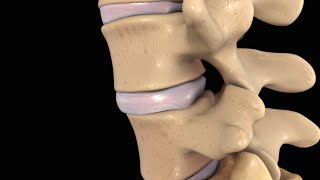 Back Pain Lumbar Disc Injury [upl. by Wiggins980]