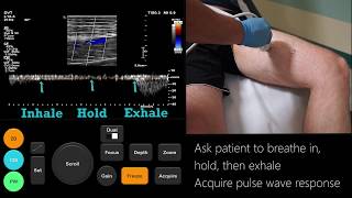 Ultrasound Tutorial DVT  Lower Limb Veins  Radiology Nation [upl. by Reckford468]