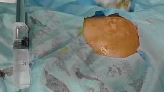 Pigtail drainage of deep subphrenic liver abscess [upl. by Amsirahc]