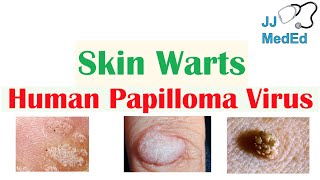 Overview of Skin Warts Verrucae  What Causes Them Who Gets Them  Subtypes and Treatment [upl. by Steady839]