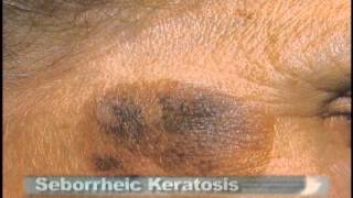 Common Skin Lesions [upl. by Karolyn]