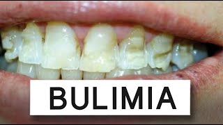 What Bulimia Does To Your Mouth [upl. by Winnie337]