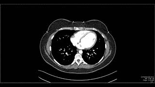 Abdominal Anatomy on Computed Tomography [upl. by Abdu]