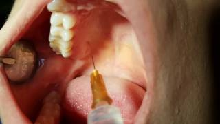 DENTAL ANESTHESIA TECHNIQUE  EXPLAINED [upl. by Eidoj]