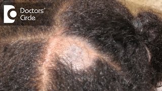 What causes Scalp Ringworm Effective Treatment   Tinea Capitis  Dr Tina Ramachander [upl. by Aenet]