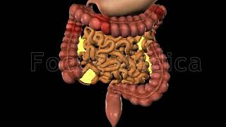 Inflammatory Bowel Disease  Crohns and Ulcerative Colitits [upl. by Blaise]