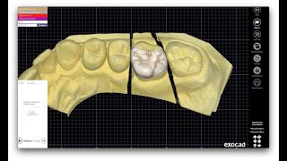 Exocad 5 minutes guide  InlayOnlay  Intarsio [upl. by Nwahsan]