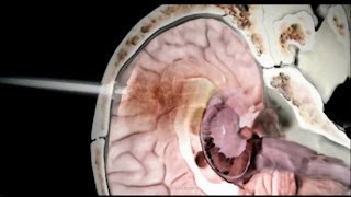 Traumatic Brain Injury  Brain Surgery Animation [upl. by Teage]