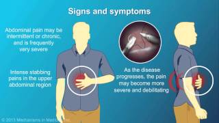 Chronic Pancreatitis [upl. by Neelrahs]