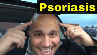 How To Treat Psoriasis On ScalpEasy Natural Remedies [upl. by Onilecram381]