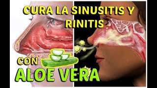 CÓMO CURAR LA SINUSITIS Y RINITIS ALÉRGICA CON ALOE VERA  LifeStyle [upl. by Anadroj]